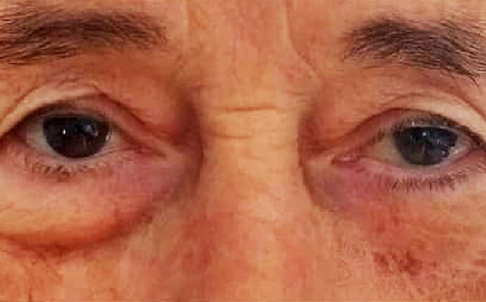 szem alatti táskák eltüntetése