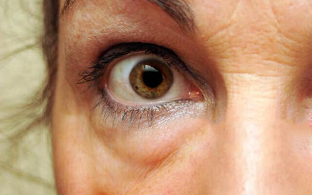 Miért táskás a szemem? – A szem alatti táskák kialakulásának okai