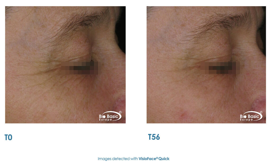 InstanTENSE Plus arszérum klinikai tesztelése