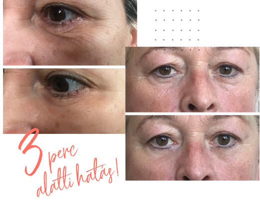 Instantense plus előtte utána