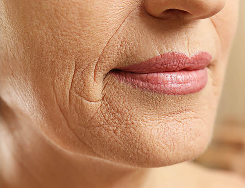 Száj körüli ráncok eltüntetése InstaTense Plus szérummal